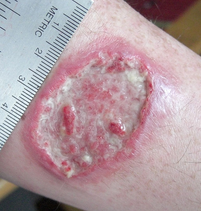 https://commons.wikimedia.org/wiki/File:Leishmaniasis_ulcer.jpg