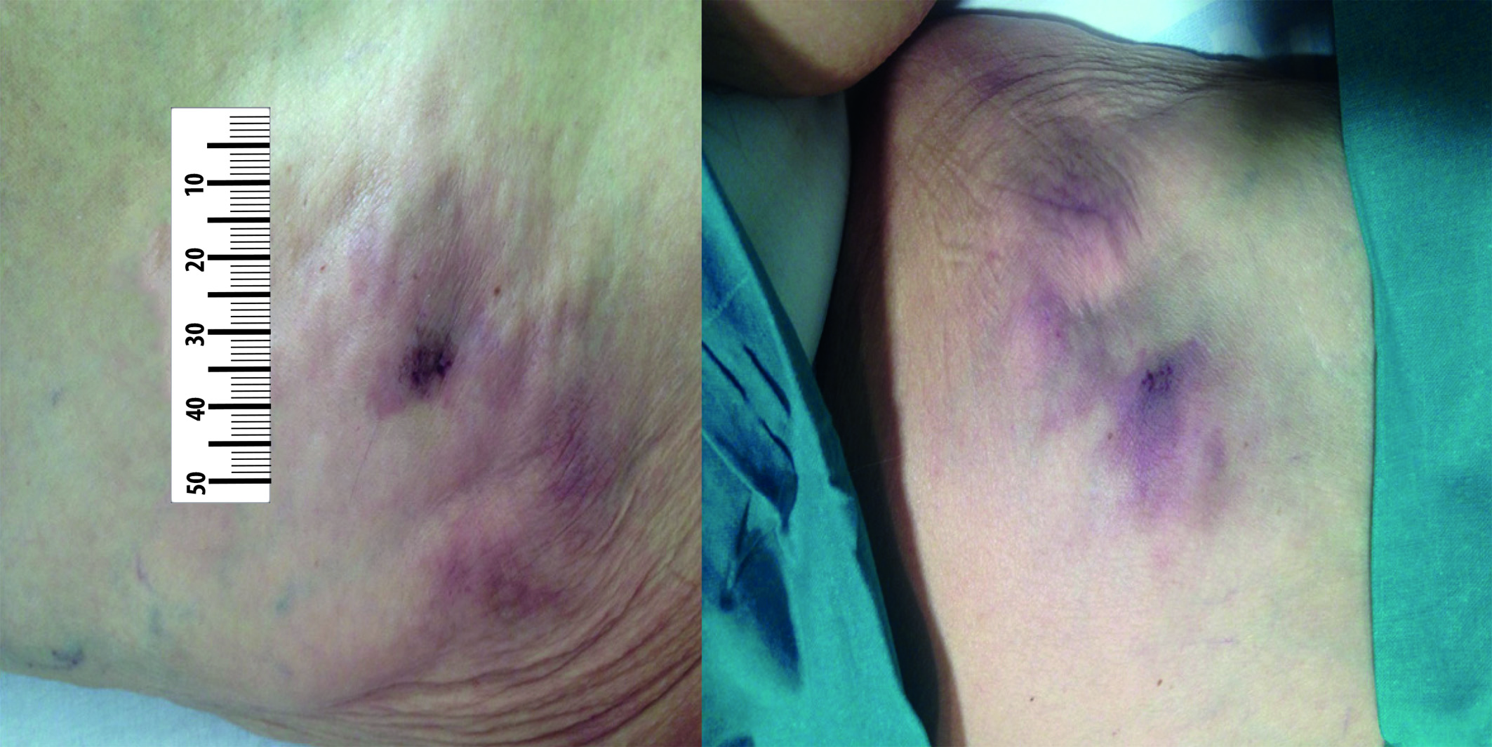 Subcutaneous, non-ulcerated and violaceous nodules on her left front and back thigh respectively, prior to the treatment.