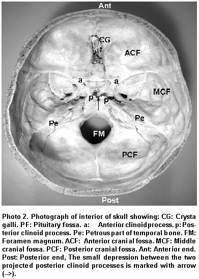 Posterior Clinoid Process
