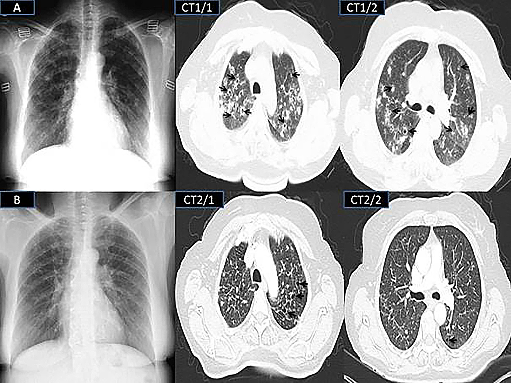 Radiography and thoracic CT images, taken at the time of admission and at 12th months of follow-up. A is showing the chest radiographic image, taken at admission, B is showing the radiographic image, taken at the 12th months of follow-up, CT1/1 and CT1/2 show the computed thoracic images, taken at the admission, and CT2/1 and CT2/2 are showing the computed thoracic images, taken at the 12th months of follow-up. Black arrows are indicating cavitary infiltrates.