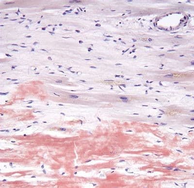 High magnification micrograph of senile cardiac amyloidosis. Congo red stain. Autopsy specimen. The micrograph shows amyloid (extracellular washed-out red material) and abundant lipofuscin (yellow granular material). 
